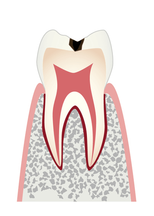 C1の虫歯