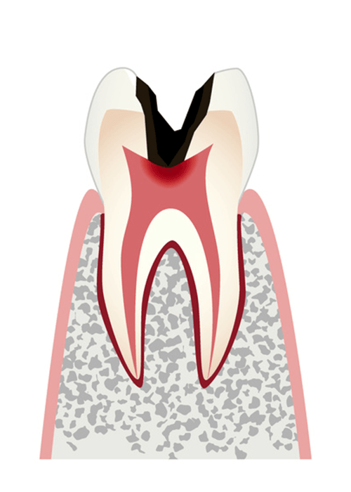 C3の虫歯