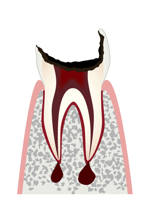 C4の虫歯
